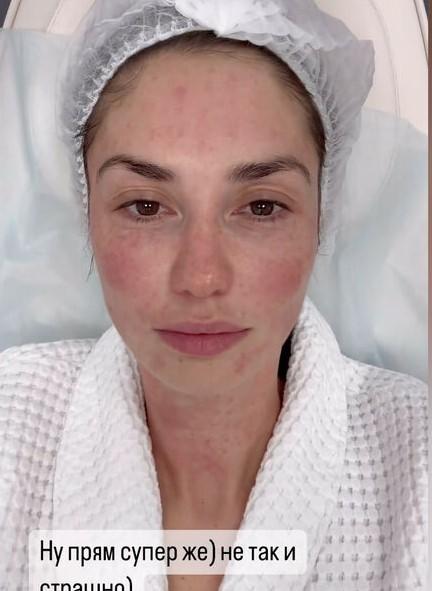 «Просто куча проколов»: Агата Муцениеце показала лицо после процедуры омоложения