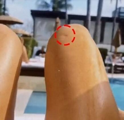 Побои или неудачная операция? Поклонники заметили шрам на теле Анны Седоковой