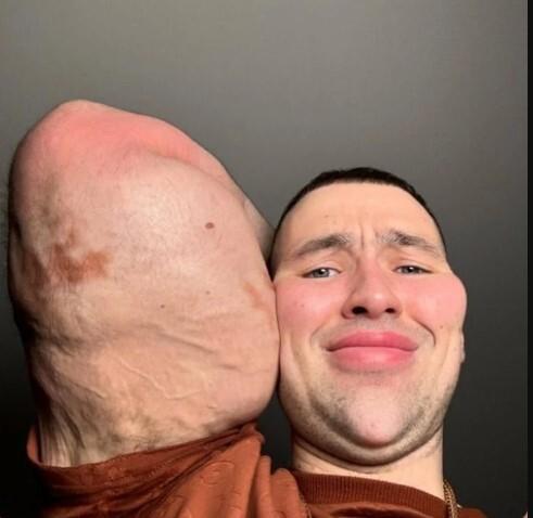 «Очень опасно и грозит отмиранием тканей»: блогеру «Руки-Базуки» могут ампутировать конечности