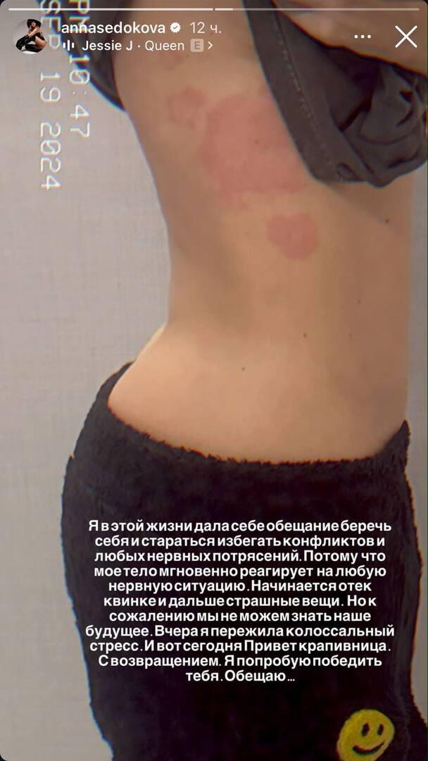 «Пережила колоссальный стресс»: Седокова пожаловалась на проблемы со здоровьем