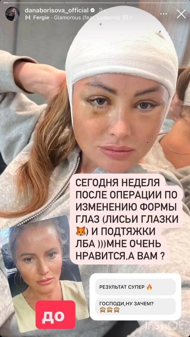 «Мне очень нравится»: Дана Борисова показала опухшее лицо через неделю после пластики