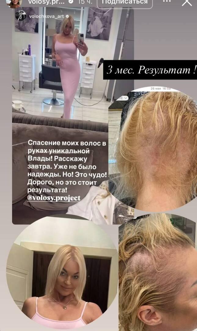 «Пошла алопеция»: почему Анастасия Волочкова начала лысеть и есть ли шанс спасти волосы без пересадки