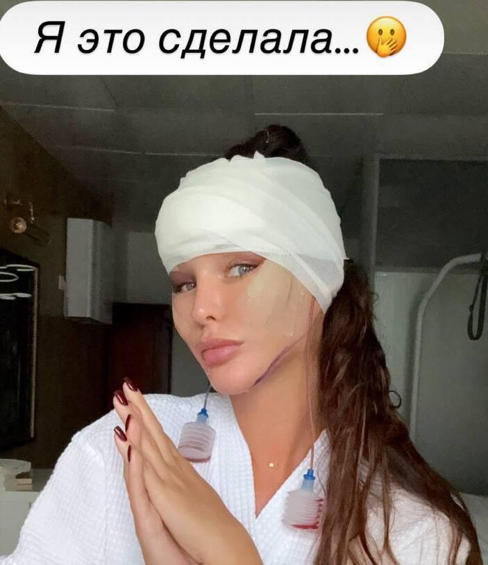 «Я это сделала»: жена Тимура Хайдарова перекроила лицо у пластического хирурга и показала результат