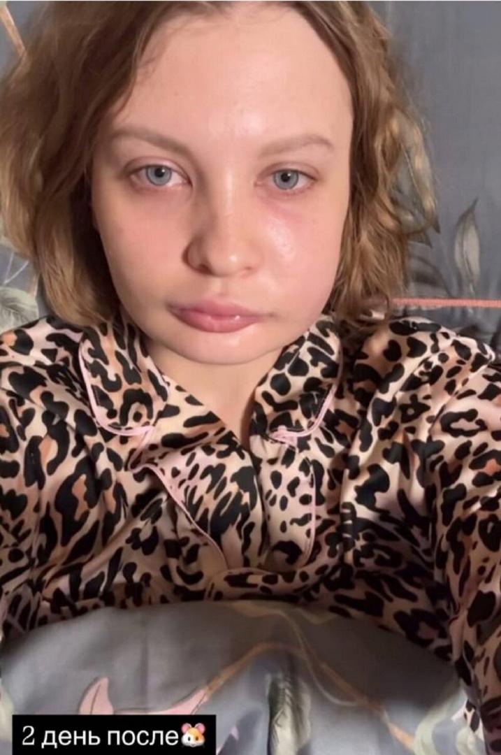 24-летняя невестка Королевой показала опухшее лицо на второй день после операции