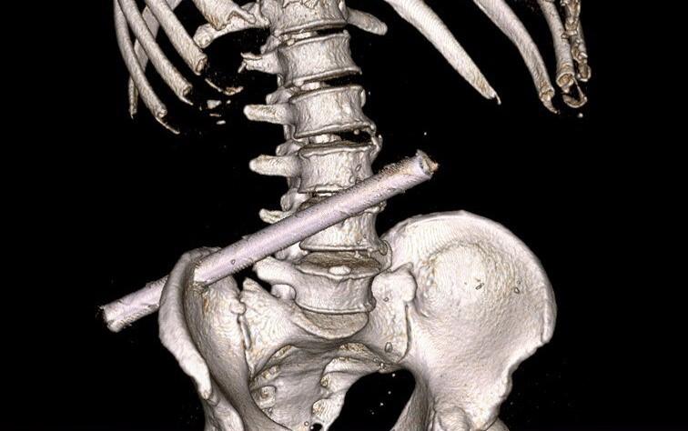 Прошла через все тело и чудом не повредила крупные сосуды: врачи достали 25-сантиметровую трубу из россиянина