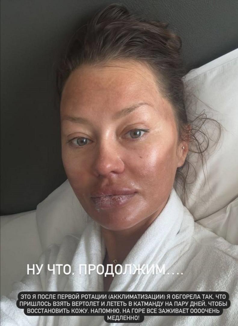 Виктория Боня заявила, что восстановила лицо после полученных ожогов в горах