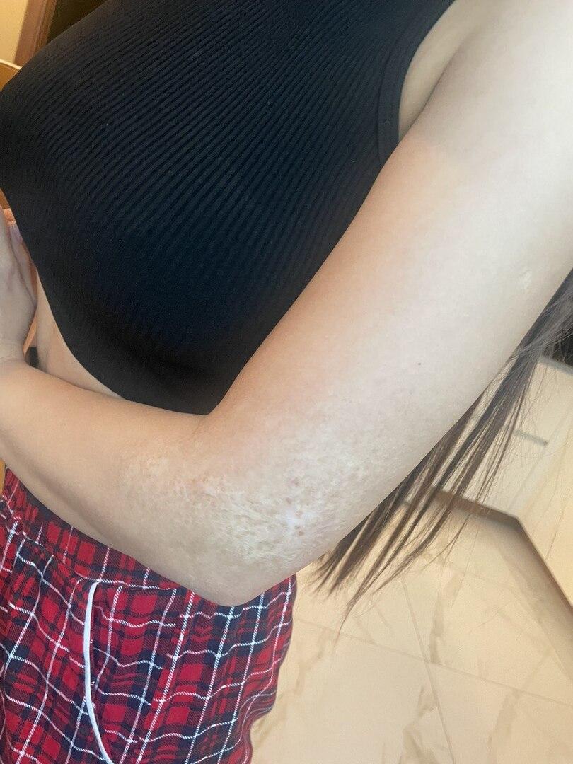 След от ожога