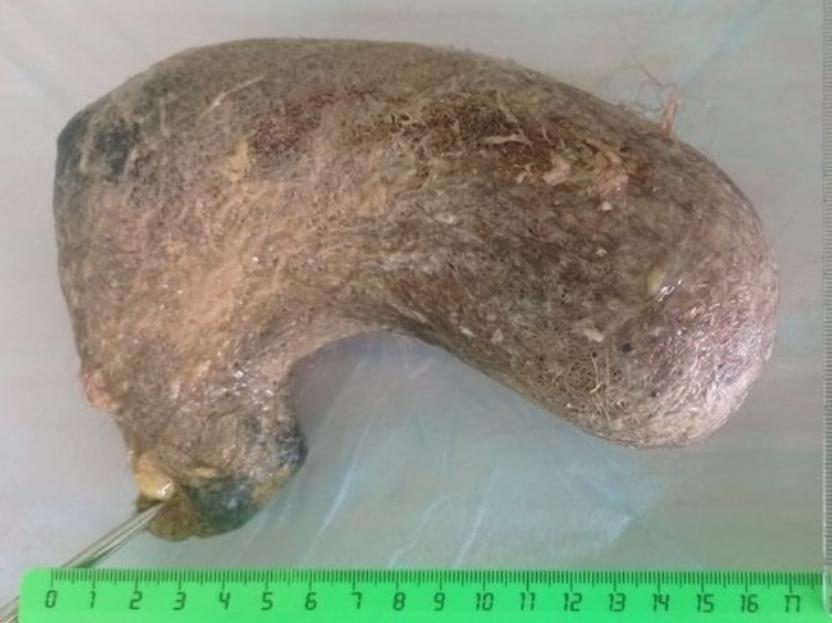 Волосяной ком из желудка 11-летней девочки
