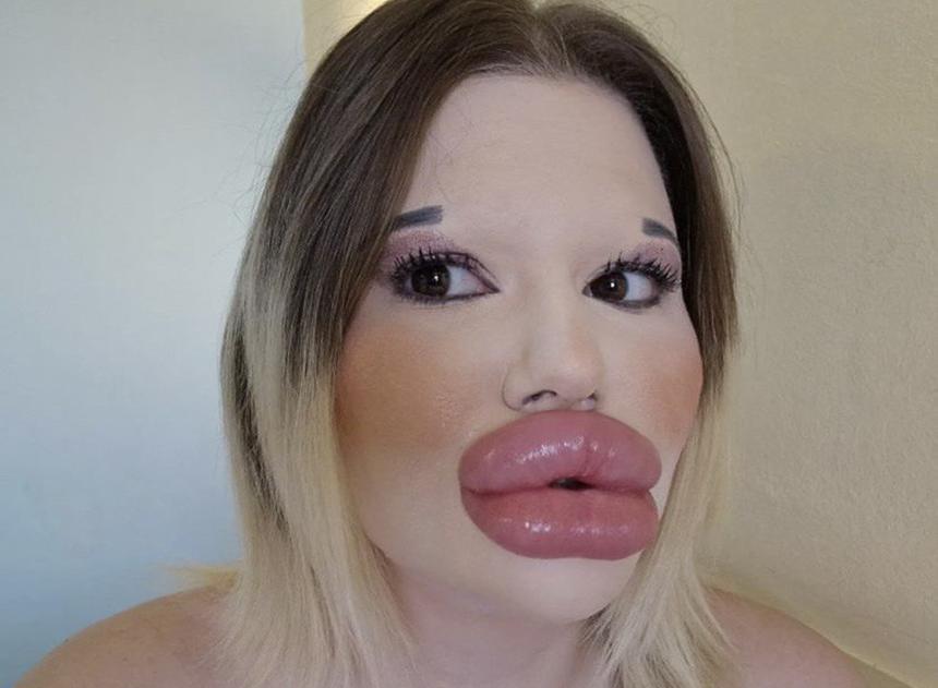 Обладательница самых больших губ в мире умрет ради нового рекорда