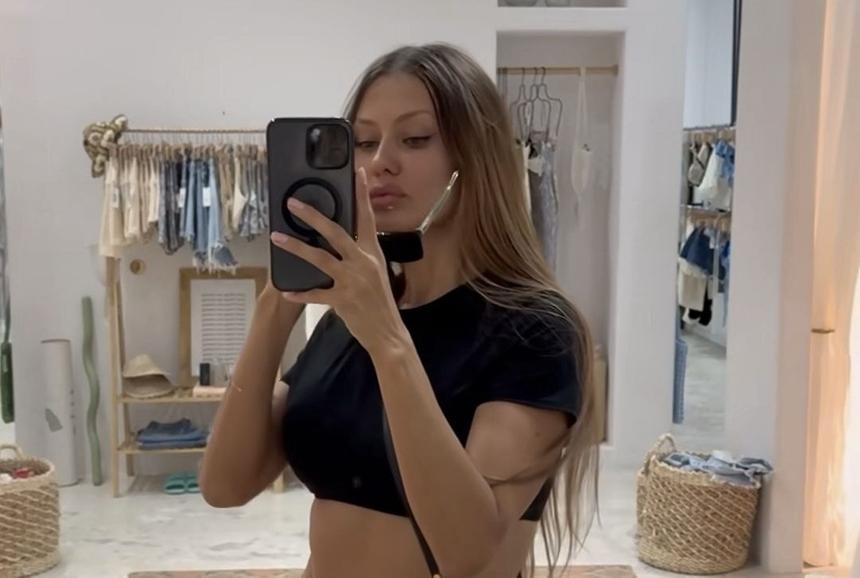 «Она старалась поддерживать красоту»: пластический хирург рассказал об огромных шрамах Бони до операции