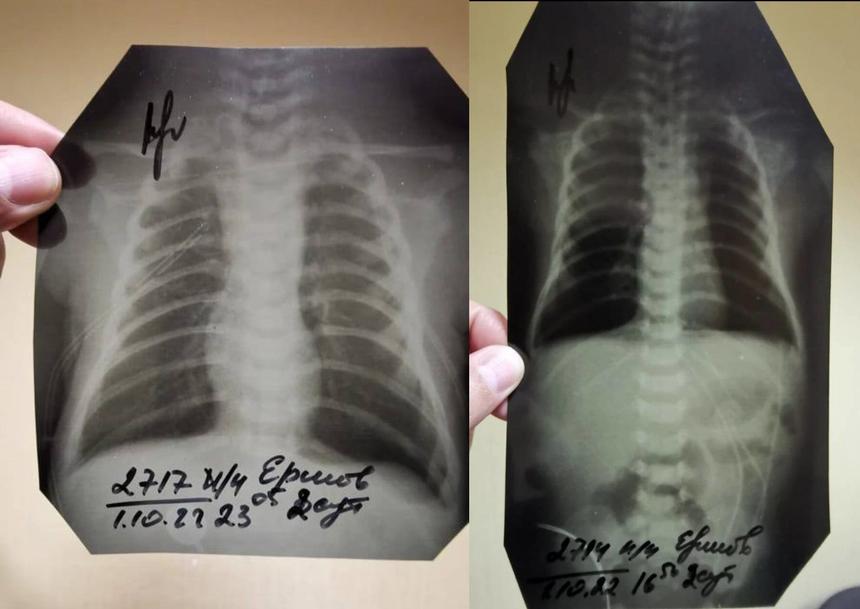 Обрезанные флюорографические снимки ребенка