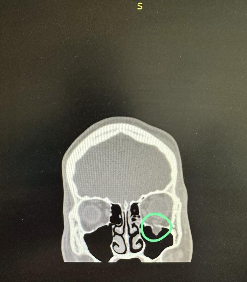 Рентгеновский снимок пострадавшего после избиения